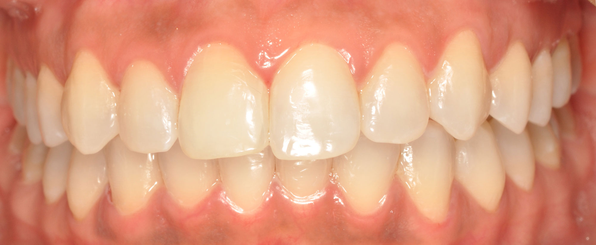 Aclarameinto-despues-1